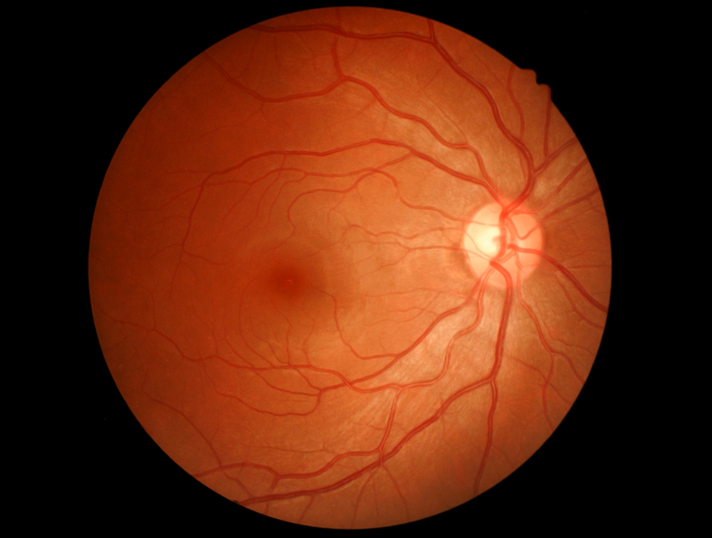 Bull's eye retinopathy in Alport