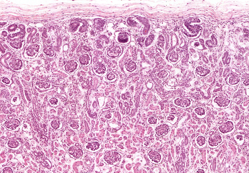 kidney tissue biopsy